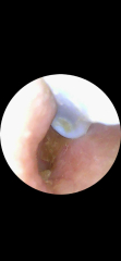 Psoriasis in ears