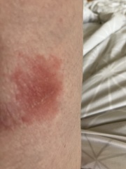 Is this a cold sore on my leg? Pic incl