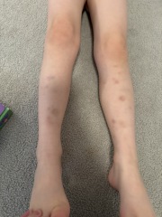 5-year old bruising