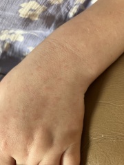 Does this look like chicken pox?