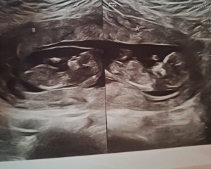 Nub theory on twins?