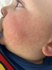 12 month old has a rash