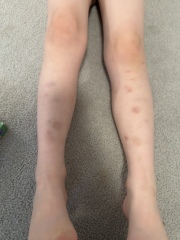 5-year old bruising