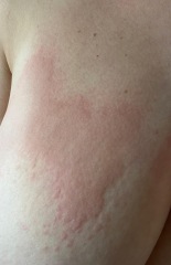 Cold rash