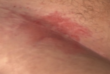 TW PICTURE - C section scar looking like this after 2 years?