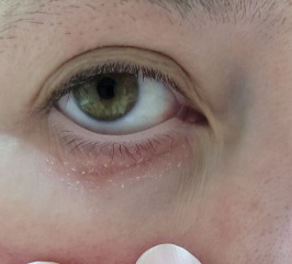 Dry cracked eyes - help?