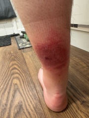 Infection after bug bite?