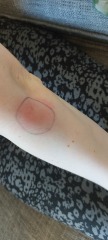 Infected bug bite - antibiotics - 9 weeks (very worried)