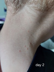 Chicken pox or Molluscum or something else 🤔