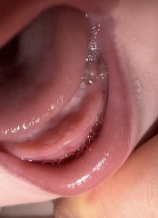 dark spots over teething baby gums