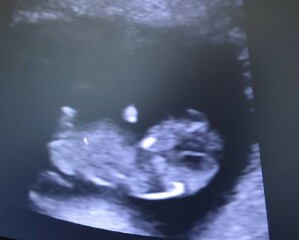 Nub at 9,5 weeks?