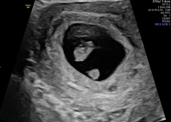 Has anyone seen placenta at 7 weeks pregnant????
