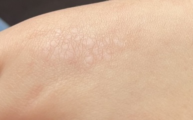 What does this look like on my daughter’s hands? Photos attached.