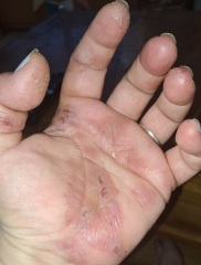 Methotrexate - Psoriasis