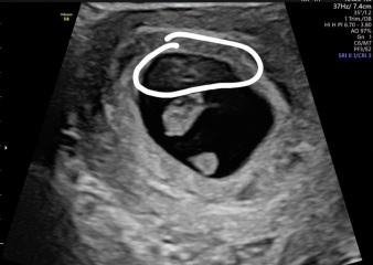Ultrasound 7 weeks 1d