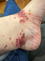 Attacked by Leeches- TMI Photos