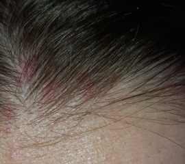 PLEASE HELP! Painful mystery rash on head!