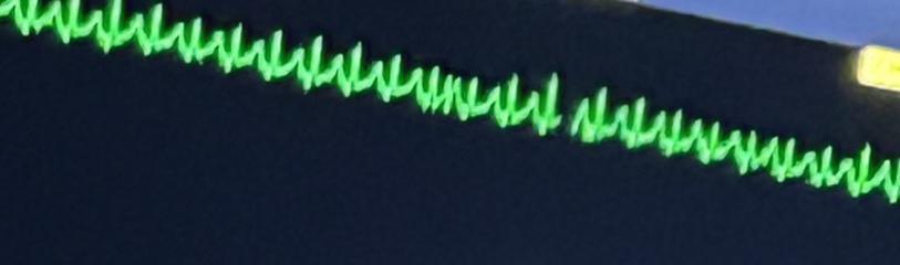 ECG question-help please!