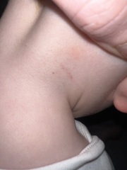 Bruises on 15 month old - are they normal?