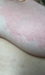 Cold rash