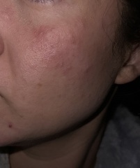 Need help with my hormonal skin at age 29?!