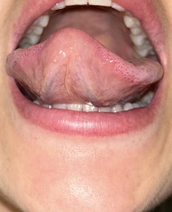 Do I have Scarlett fever !? Photos attached