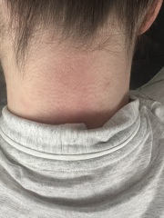Relating to earlier post (lump on neck)