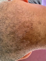 Scalp rash help - ringworm or psoriasis?