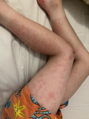 Strange rash coming and going on DS