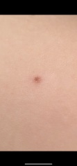 Mole changes