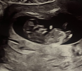 Scan picture, lump on head.