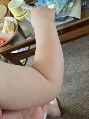 Slapped cheek or allergy?