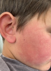 Is this slapped cheek in a 10 year old?