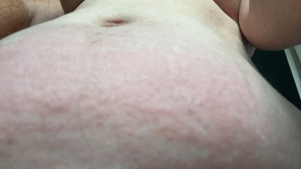 Any ideas on rash? Driving me mad!