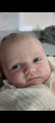 Little spots on babies face