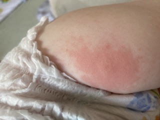 Help! Is this a bee sting?