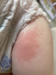 Help! Is this a bee sting?