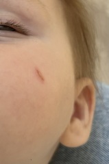 Guilt… Finger nail scratch toddler face