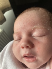 Little spots on babies face