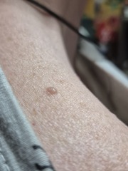 Skin cancer or something else?