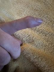 Osteoarthritis in finger joints