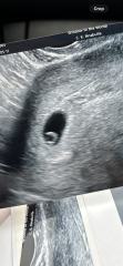 Scan at 4 weeks. Pregnancy of unknown location