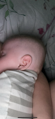 Flat head in my 4 month old. Is this severe??