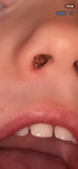 Dried snot in babies nose