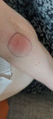 Infected bug bite - antibiotics - 9 weeks (very worried)