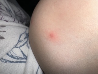 Blisters. What’s is this??? 