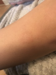 Is this ringworm?