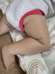 Mild Hand Foot & Mouth 9 Month Old