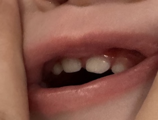 14 months teeth