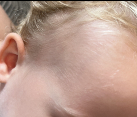 Fine hair on toddlers face?